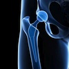 early re-operations for hip prostheses, quality of results